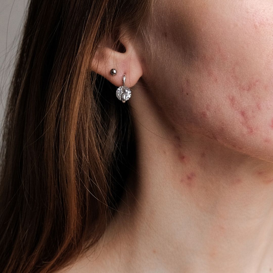 5 Anzeichen, dass Du es mit hormoneller Akne zu tun hast – und wie man sie behandelt